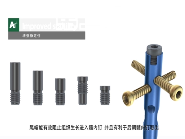 脛骨解剖型交鎖髓內(nèi)釘